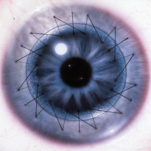 高透光人工角膜（E-Col）